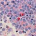 New Report Raises Awareness of Growing Cancer Cases