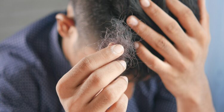 Hair Loss Patients Given New Hope
