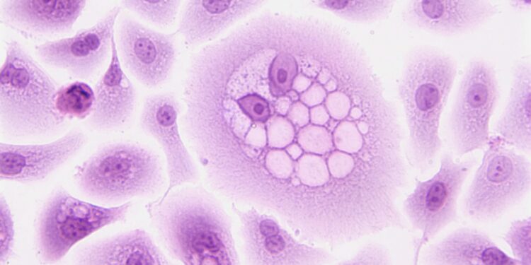 Almost 50% Of Cancer Cases Tied To Lifestyle Choices