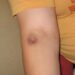What Pigment Causes The Yellow Hue Of Healing Bruises?