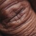 What Condition Causes White Patches From Loss Of Skin Pigment?