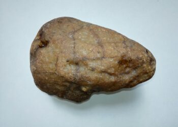 Blood Test Uncovers Fatty Liver Disease Before Symptoms Appear