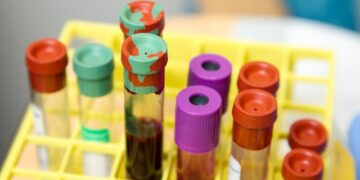 Dark urine could indicate a liver problem