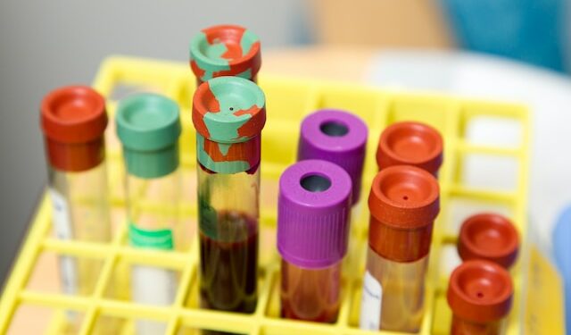 Dark urine could indicate a liver problem