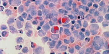 New Report Raises Awareness of Growing Cancer Cases