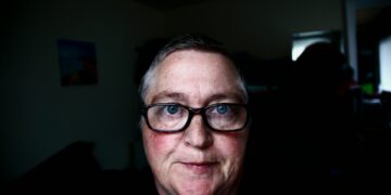 Conquer Rosacea And Reclaim Confidence