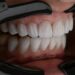 What Is The Leading Cause Of Tooth Loss In Adults?