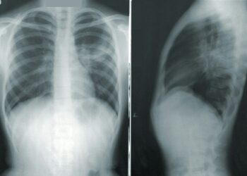 Lung Cancer Screenings Proven To Save Lives