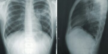 Lung Cancer Screenings Proven To Save Lives