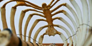 What Is The Term For A Condition Characterized By The Thinning And Weakening Of Bones?