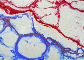 What Is The Condition Caused By Narrowed Blood Vessels Due To Plaque Buildup?