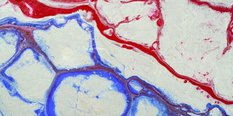 What Is The Condition Caused By Narrowed Blood Vessels Due To Plaque Buildup?