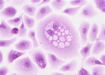 Almost 50% Of Cancer Cases Tied To Lifestyle Choices