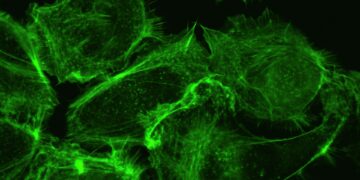 What Is The Most Common Cause of Hypothyroidism Worldwide?