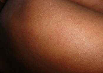 Measles Epidemic Escalates In 2024