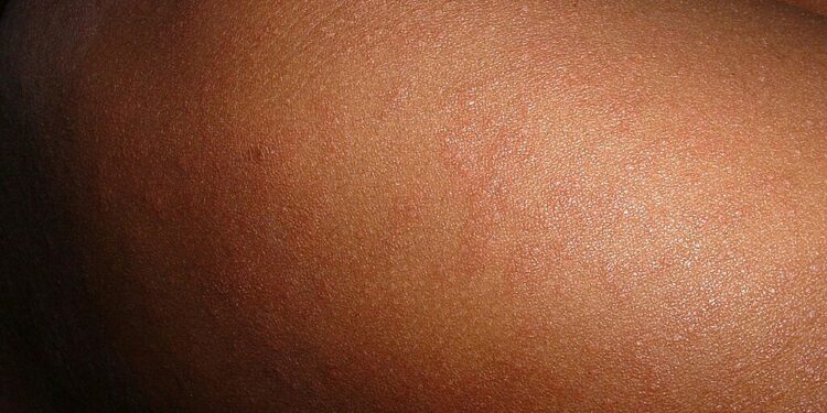 Measles Epidemic Escalates In 2024