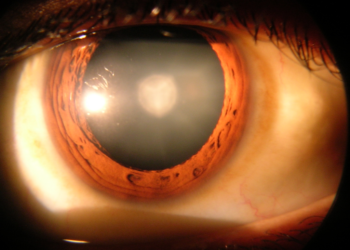 Groundbreaking Research Discovers Non-Surgical Cataracts Cure