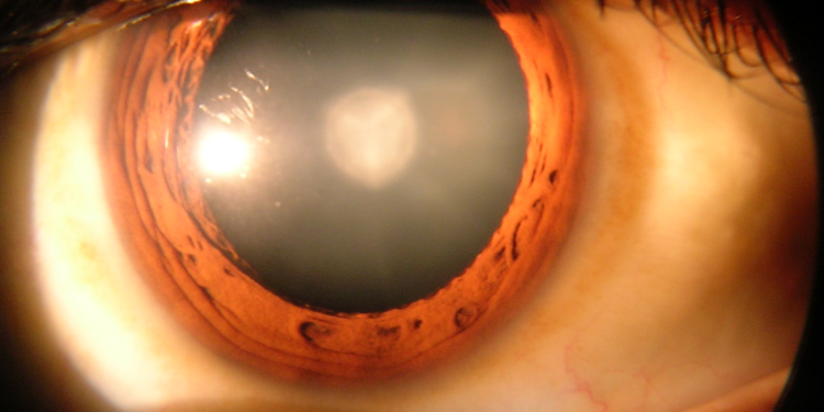 Groundbreaking Research Discovers Non-Surgical Cataracts Cure