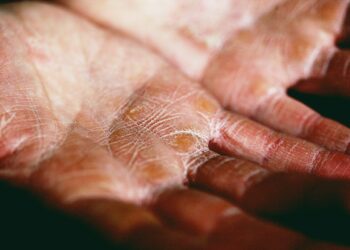 Leg Artery Concerns For Eczema Patients