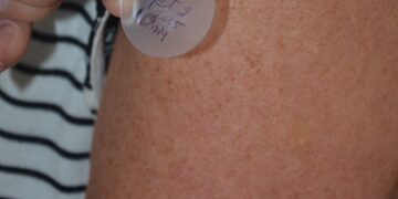 High-Tech Skin Patch To Revolutionize Blood Pressure Monitoring