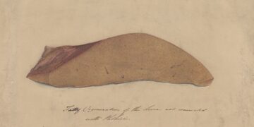 Fatty Liver Disease Hits 40% Of U.S. Adults