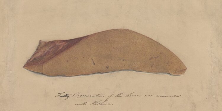 Fatty Liver Disease Hits 40% Of U.S. Adults