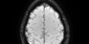 What Does The Pineal Gland Do?