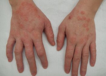 The Shocking Treatment For Eczema