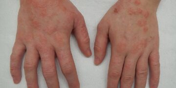 The Shocking Treatment For Eczema