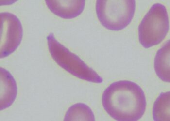 The Hidden Cost Of Sickle Cell