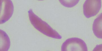 The Hidden Cost Of Sickle Cell