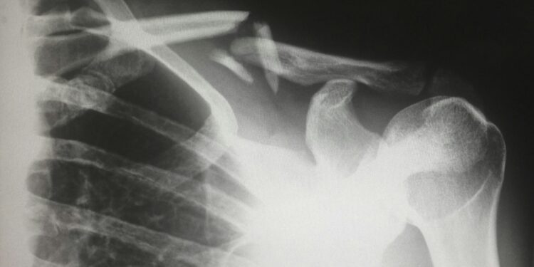 What Is The Term For The Process Of Breaking Down And Forming New Bone Tissue?