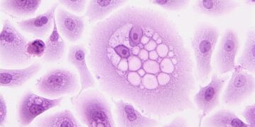 AI Proves Crucial In Detecting Ovarian Cancer