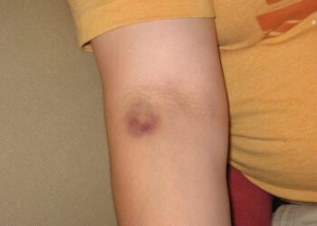 What Pigment Causes The Yellow Hue Of Healing Bruises?