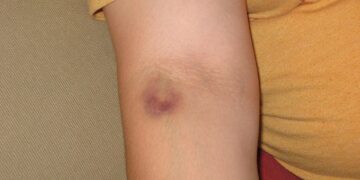What Pigment Causes The Yellow Hue Of Healing Bruises?