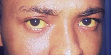 What Is The Condition Where The Skin Turns Yellow From Bilirubin Buildup?