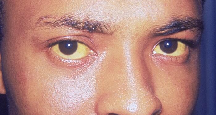 What Is The Condition Where The Skin Turns Yellow From Bilirubin Buildup?