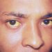 What Is The Condition Where The Skin Turns Yellow From Bilirubin Buildup?