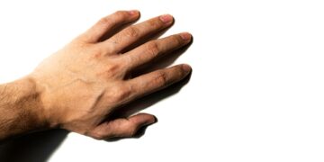 What Is The Medical Term For Blood Clots In Deep Veins?