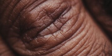 What Condition Causes White Patches From Loss Of Skin Pigment?