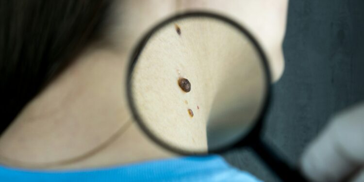 New Tech Sharpens Skin Cancer Detection