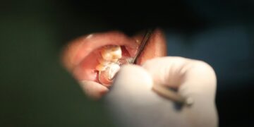 Fluoride Ban Could Cause Cavity Catastrophe